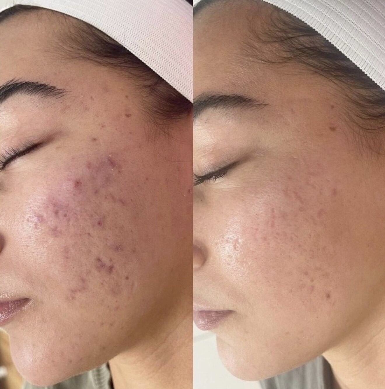Acne Facial treatment result