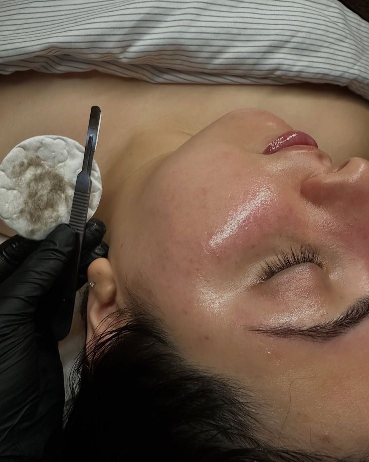 Dermaplane treatment result
